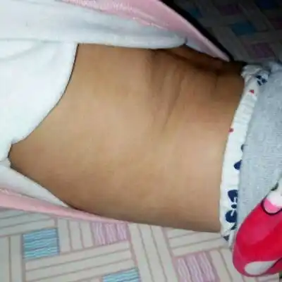 起红疙瘩 给摸的药 在十一个多月发现孩子身上色素沉着 黑一块一块的