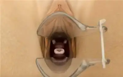 上环手术全过程附图上环后真是哭都没眼泪