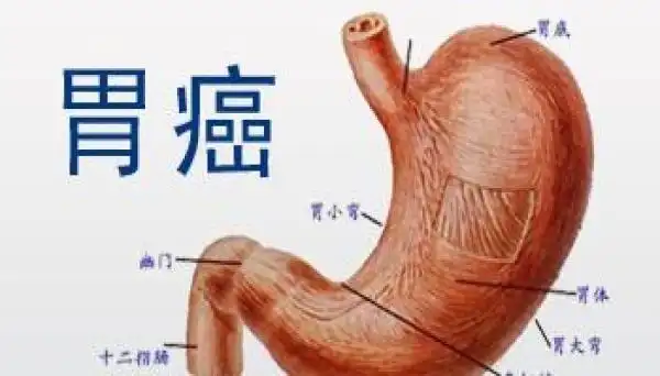 32岁小伙仅半年把胃溃疡拖成胃癌,医生:有这5个症状千万不敢拖