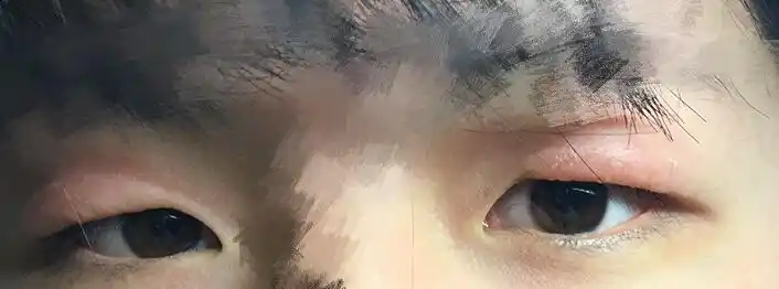 贴了双眼皮胶导致眼皮发炎,还红肿,又很痒,怎么办?热敷消肿有用吗?