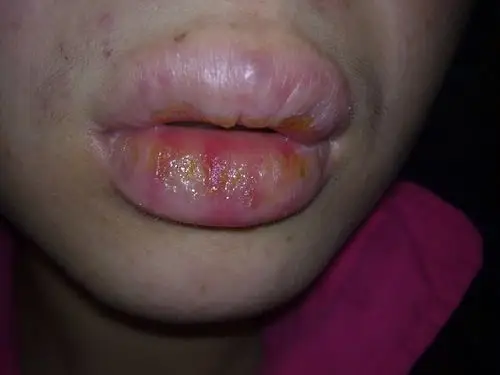 你好,我想咨询下,唇炎你是开了什么中药治好的还记得吗,一直脱皮真的