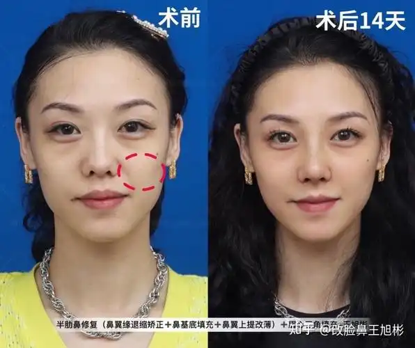 做鼻基底填充就能消灭法令纹?没你想得那么简单! - 知乎