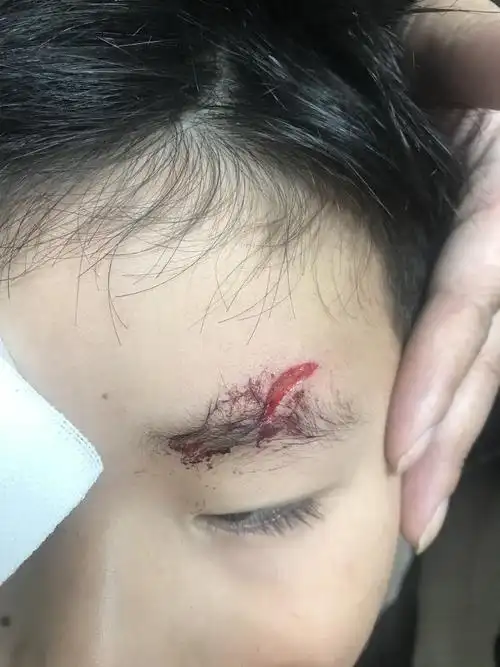 安阳拓普五官医院超精细缝合一例