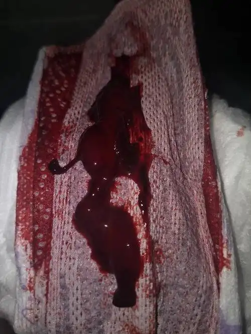 第一天颜色有点深,第三天好多血块这正常么?