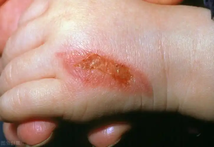 火碱烧伤皮肤如何治疗,火碱烧伤皮肤如何治疗挂掉水消炎吗可以吗