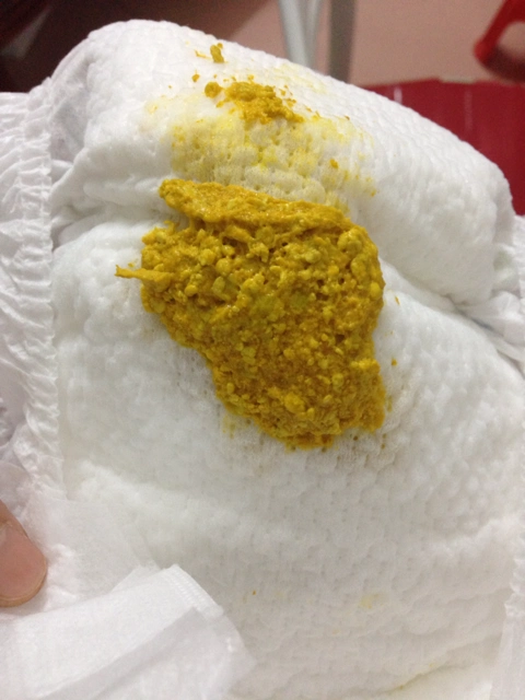 导致的如果一次性吸入过多的母乳过多,可能会引起宝宝消化不良的症状