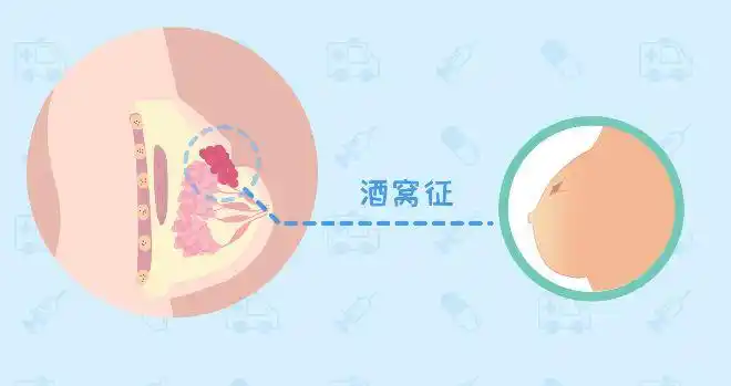 初潮早 ,绝经晚的人都要小心乳腺癌?