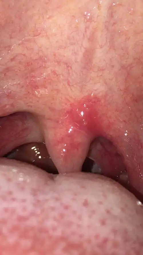 卖榨菜肉丝,吃一半突然感觉口腔很痛,照片拍下来发现小舌头一边红肿了