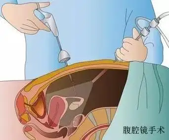 异位妊娠手术编码解析,干货满满!