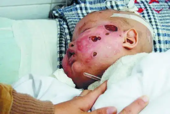 福建男孩脸部溃烂来京求医 数万网友爱心接力