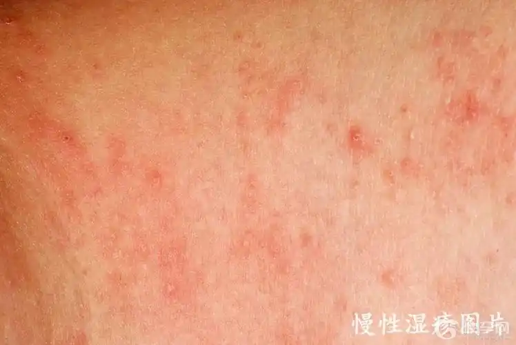 湿疹图片初期症状各种类型湿疹图片对照查看大全