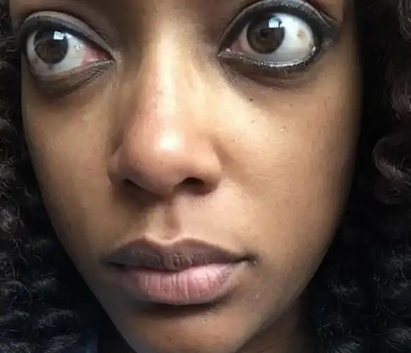 眼部周围组织肿胀,眼球外凸,好像眼球都要掉出来了.