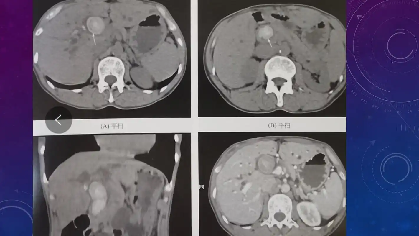 急腹症影像:胆道结石ct表现!