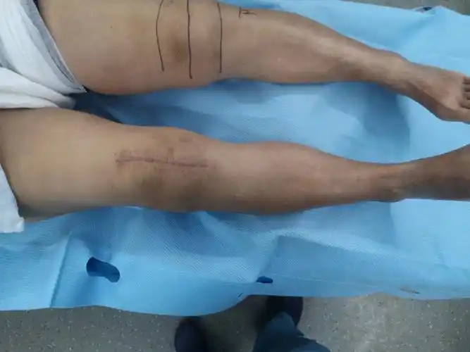 前做了右侧全膝关节置换,术后患者感觉恢复很好,所以这次来做左膝手术