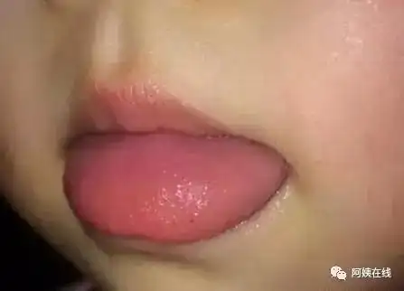 艾滋病初期表现舌头,出现舌头症状还需注意其它并发症
