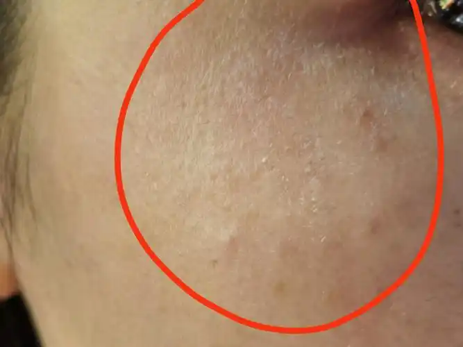 秋冬干燥,起皮脱屑