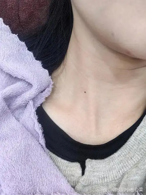 脖子长痣有什么讲究么 左边脖子长痣,说这个位置容易受委屈,不好,是不