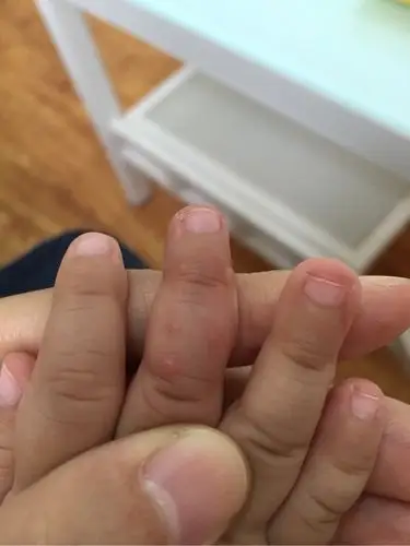 于连红医生:手足口病防护秘籍已备好!宝宝再也不用怕