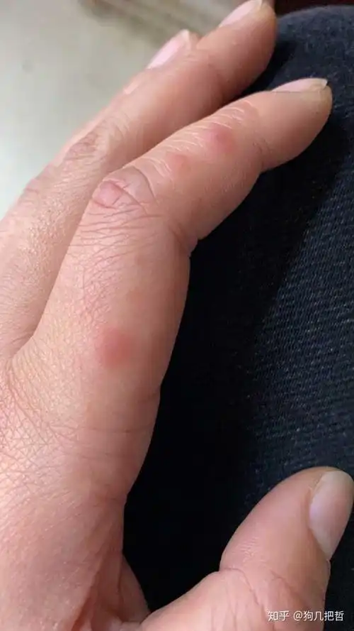 手上长水泡又疼又痒