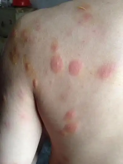 湿毒图片 (18)_有来医生