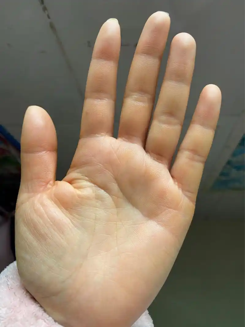 有谁知道手掌心发黄是什么原因吗?