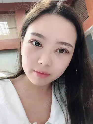 眼综合整形术后1天_全切双眼皮术后1天_眼型矫正术后1天_眼综合术后1