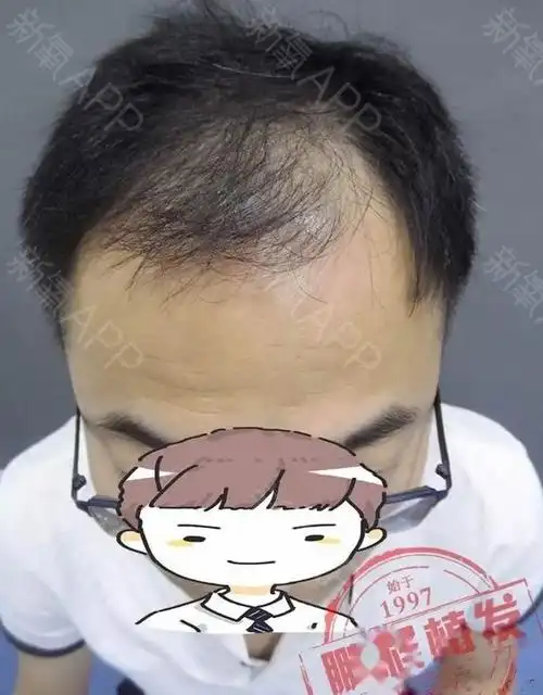 我是四级脱发,是由于精神压力过大导致的发际线后退,_圈子-新氧美容