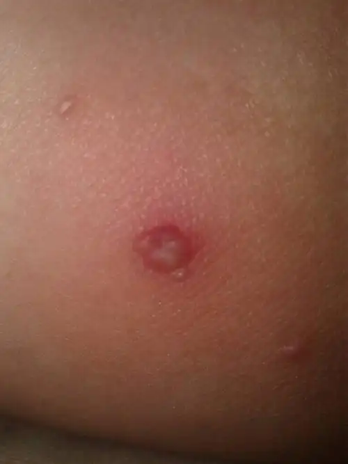 一周前发现大腿内侧长了小肉粒,1