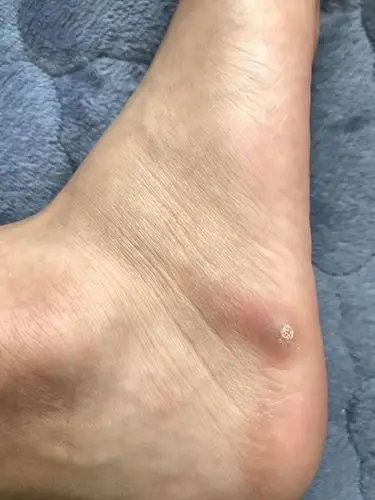 脚上起了一个硬包 一按就痛