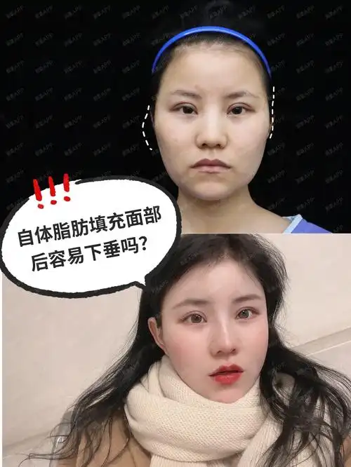 自体脂肪填充面部后容易下垂吗?