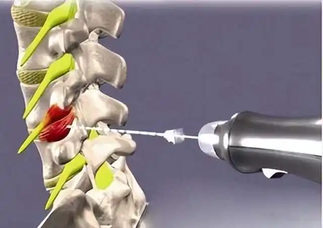 怎样给腰椎间盘突出消炎止痛都有哪些中药和西药