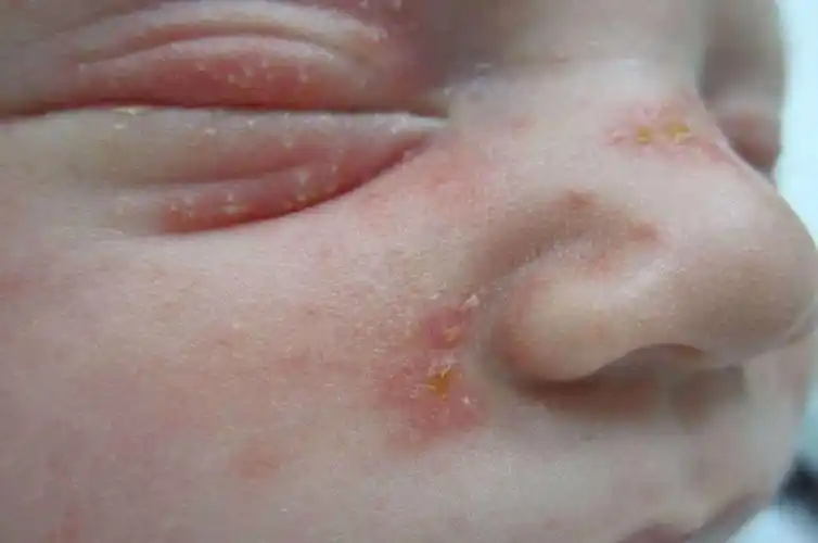 疫情防控期间孩子发皮疹怎么办