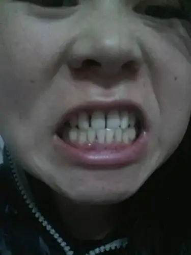 27岁,牙龈萎缩,怎么办?