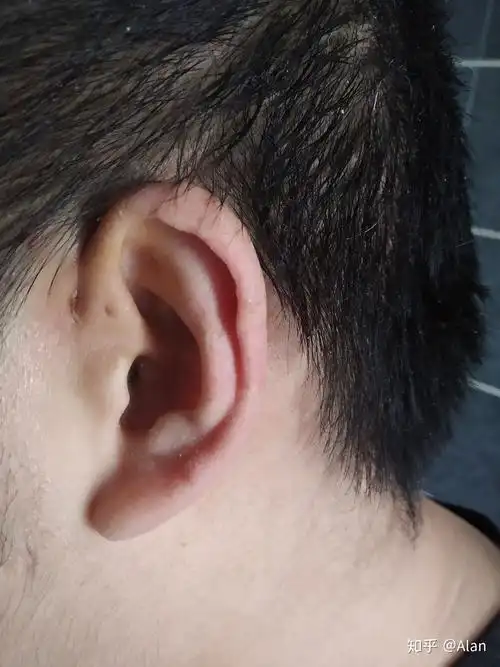 记录一下耳前瘘管发炎化脓,到手术摘除的过程. - 知乎