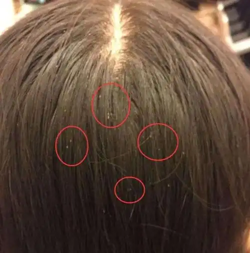 附在头发上的"白卵"是什么?