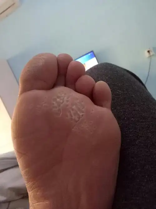 脚流汗,脚臭,脚底如图,像一个个小洞洞一样,请问这是鸡眼,还是脚气?