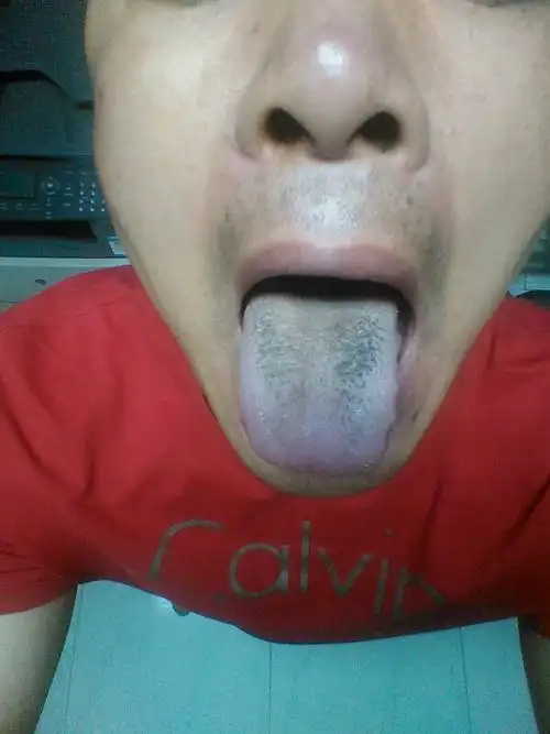 舌苔发黑,什么问题?