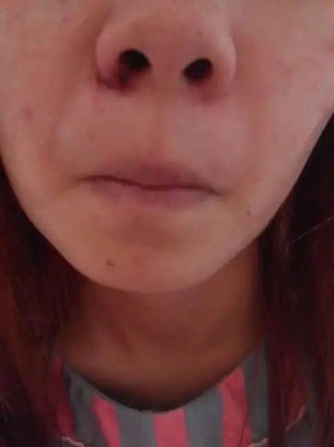 鼻子这样了请问下宝妈们能用药膏吗?要用什么药膏才不会对小孩不好?