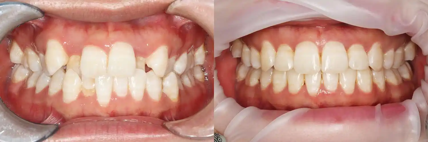 生活照矫正前后对比:虎牙妹子矫正结束后不仅排齐了牙齿,完成了笑容