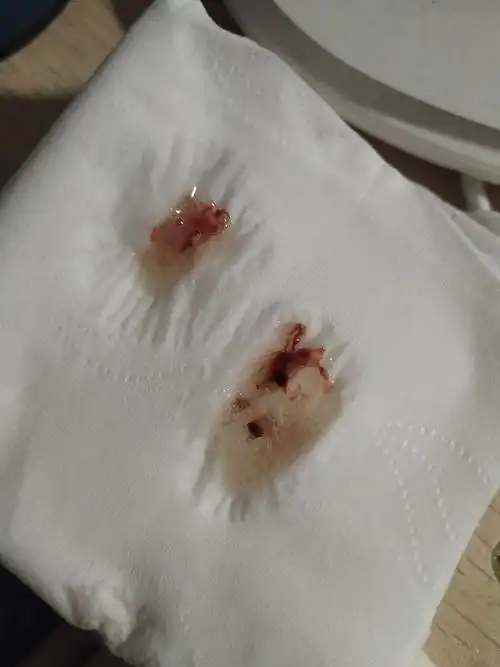 早上起床吐的痰带血