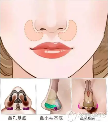 兰州时光教你怎么判断鼻基底凹陷有bug可选假体填充