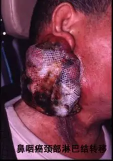 鼻咽癌的表现_鼻咽癌_症状_症状表现 - 好大夫在线