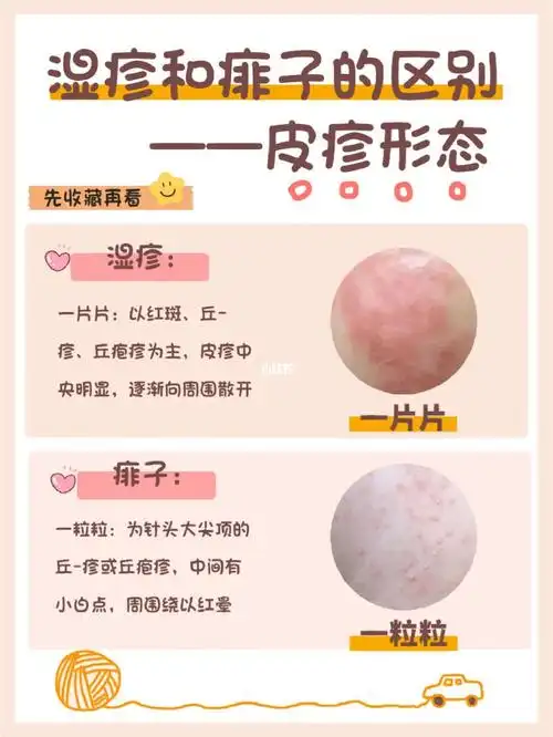 湿疹痱子怎么区分71一篇就看懂