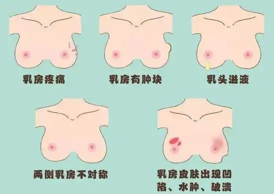 位置,颜色是否正常,两侧乳房是否对称,乳头有无凹陷,皮肤有无褶皱