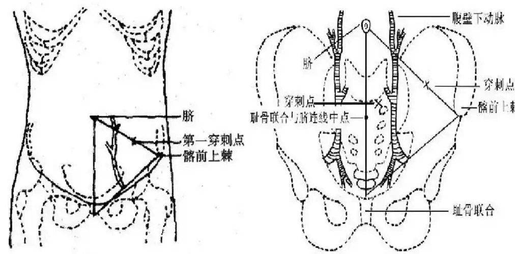 腹腔穿刺术(abdominocentesis)的理论与实践 - 知乎