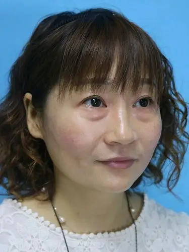 我做的是外切眼袋,效果太明显了,恢复起来也很快,可_圈子-新氧美容