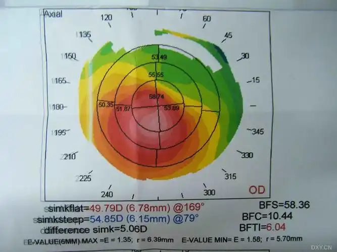 【分享】角膜地形图
