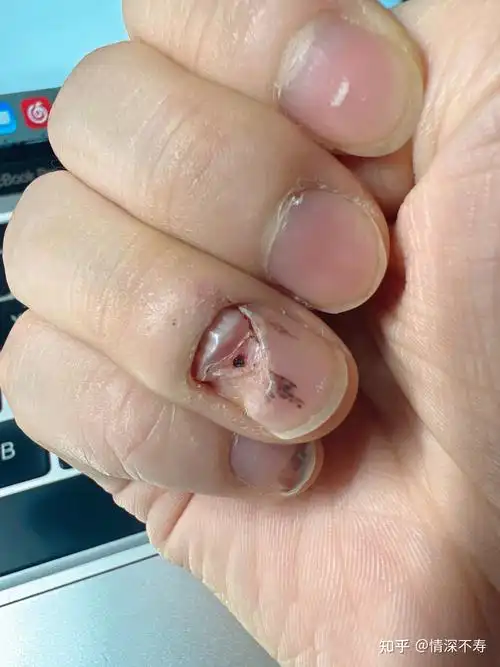 刚修掉指甲的时候新指甲很软,下午就变硬了,应该早点把旧指甲修掉的.