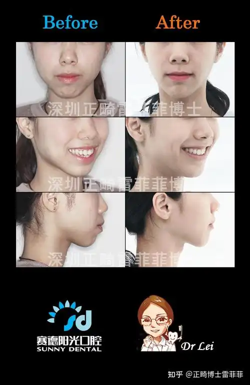 怎样判断嘴凸是骨性的还是牙性的? - 知乎