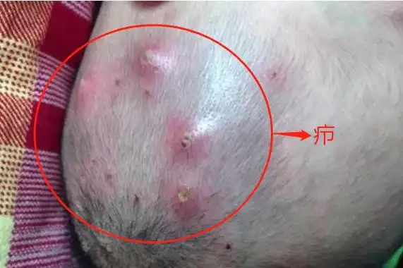 后脑勺长包图片